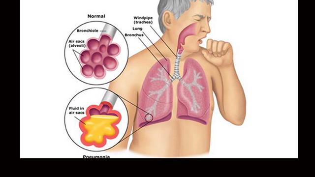 Perhatian Penyakit TBC Menurun, Pemeriksaan Dahak akan Dilakukan